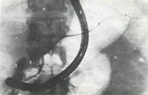 рентгенограма проток підшлункової залози