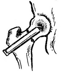 металоостеосинтез перелому шийки стегна