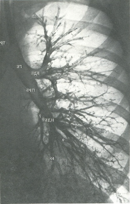 бронхіальне дерево правої легені в прямій проекції