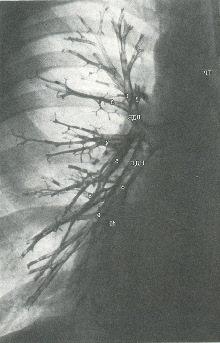 бронхіальне дерево лівої легені в прямій проекції