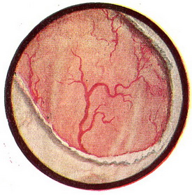 лейкоплакія сечового міхура
