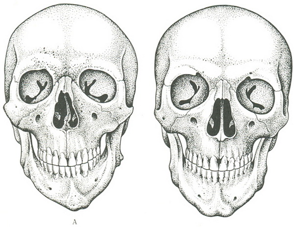 асиметрія черепа дорослої людини