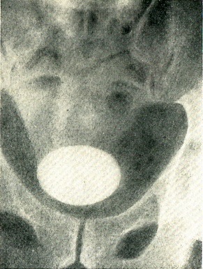 камінь сечового міхура рентгенограма