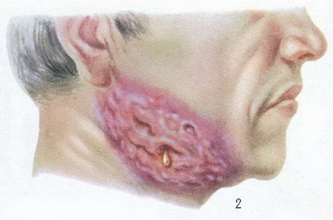актіномікоз шийно-лицьової області