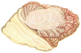 медулобластома мозочка