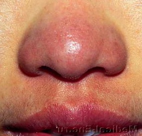 червоний гранулез носа