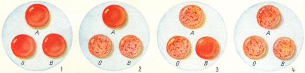 визначення груп крові