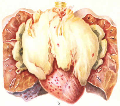 гемоцитобластоз