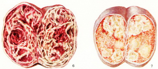 хоріонепітеліома та рак яєчка