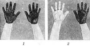 пітливість рук