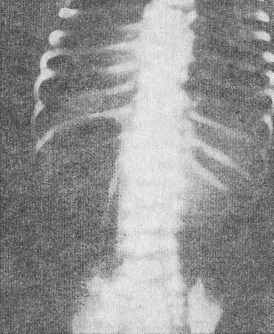 рентгенограма новонародженого з препилорической атрезією