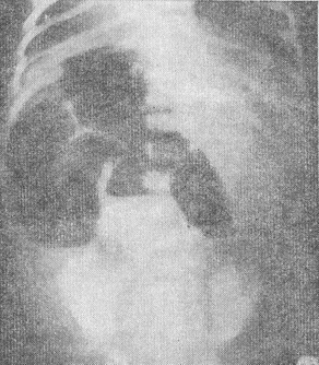 рентгенограма новонародженого з тонкокишковій непрохідністю