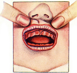 дуплікатура слизової оболонки