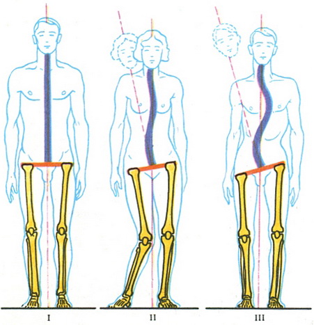 формування сколіозу