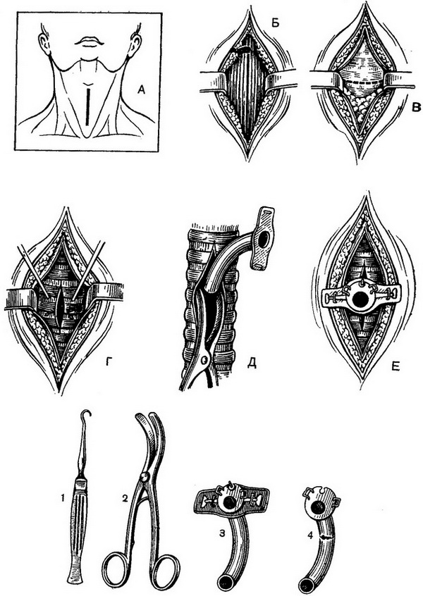 трахеостомія