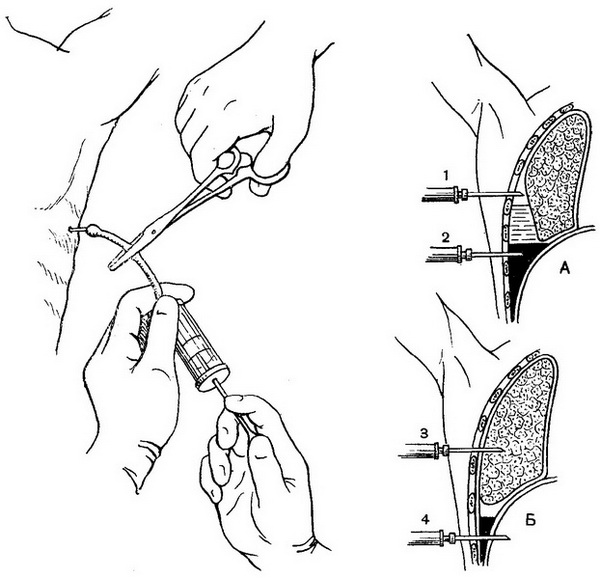 плевральна пункція