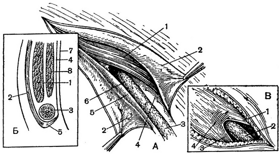 паховий канал (схема)