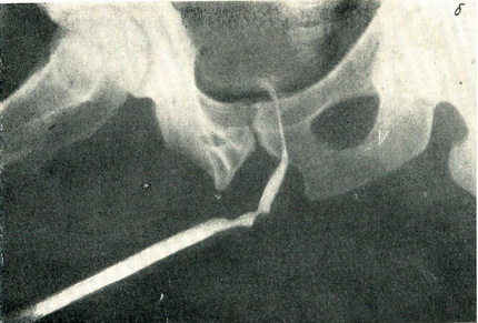 уретрограмма при травматичної стриктуре уретри