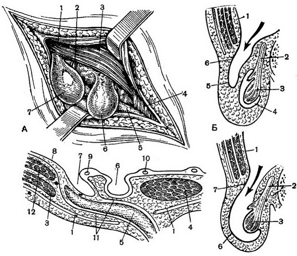 пахові грижі