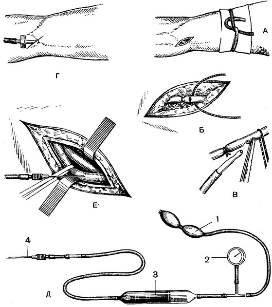 венесекція для введення канюлі