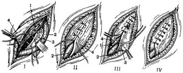 етапи операції пластики пахового каналу