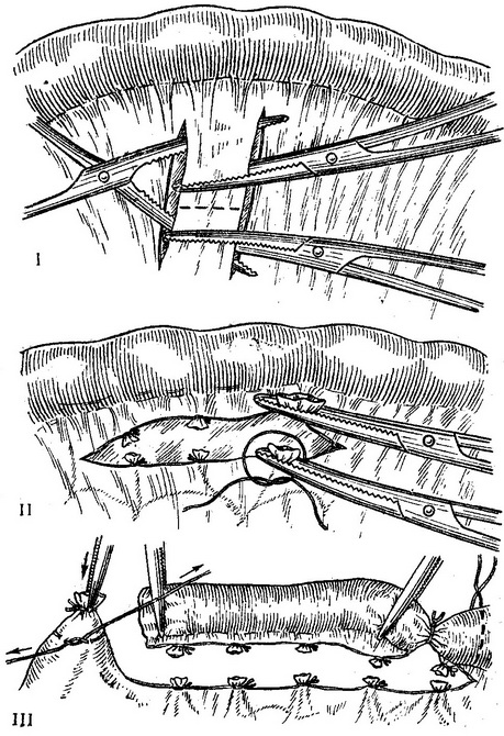 резекція тонкої кишки техніка перев'язки судин брижі