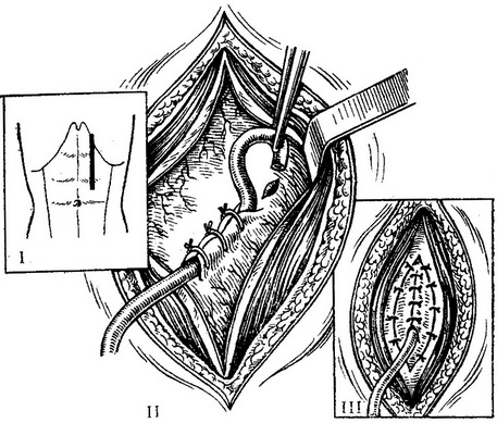 гастростомія за Вітцелем