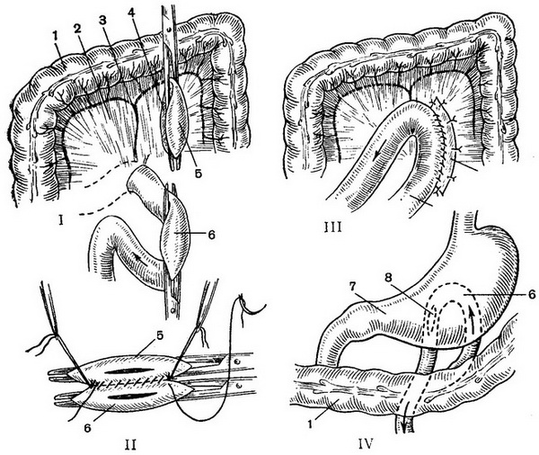 задня позадиободочная гастроэнтеростомия за Петерсену
