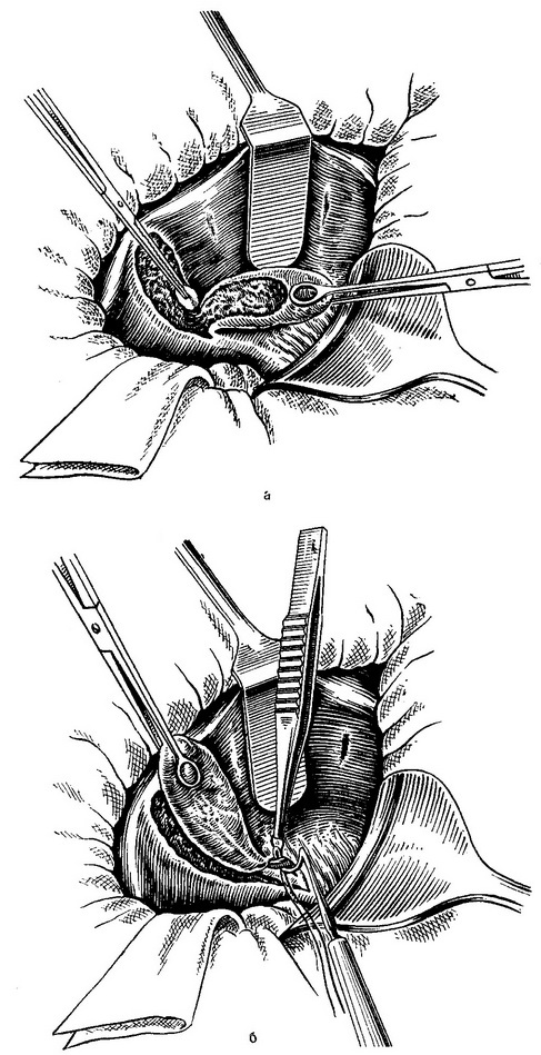 операція видалення жовчного міхура