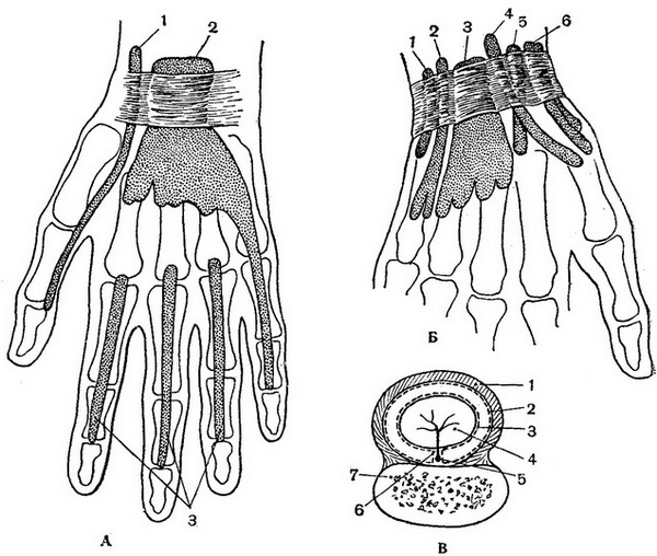 синовіальні піхви сухожилків долонній і тильній поверхні правої кисті