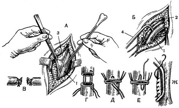 операції на судинах