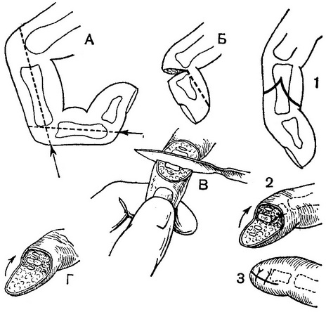 ампутації верхньої кінцівки