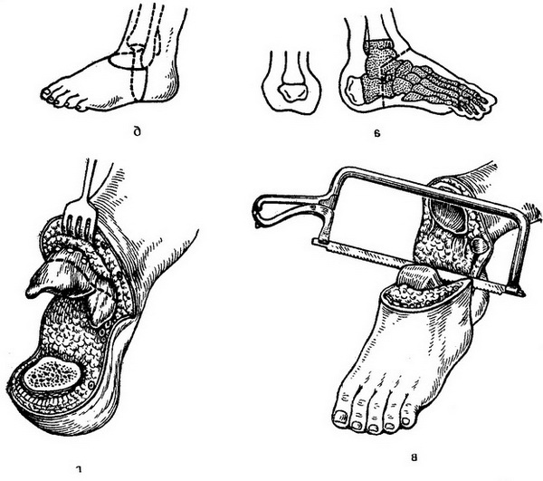 костнопластическая ампутація гомілки за Пироговим