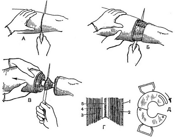 ампутація стегна трехмоментным конусо-круговим способом Пирогова