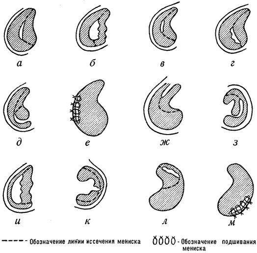 види пошкоджень менісків