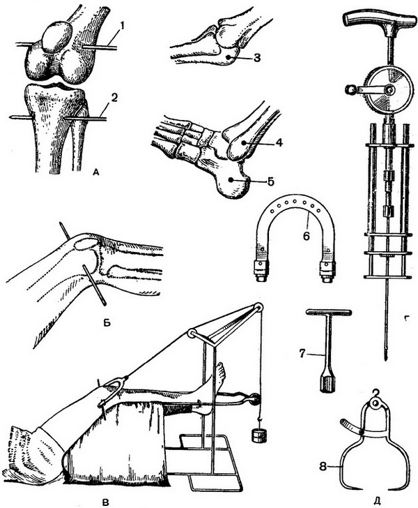 скелетне витягування