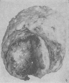 листоподібна пухлина