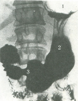 рентгенограма шлунка і дванадцятипалої кишки
