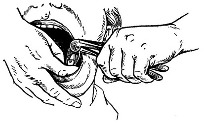 видалення зуба на правій половині нижньої щелепи