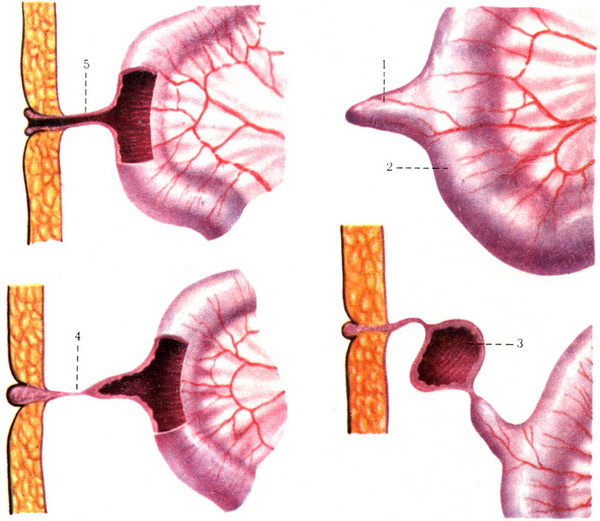 аномалії розвитку тонкої кишки