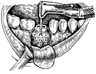 схема роз'єднання коренів нижнього моляра фісурним бором