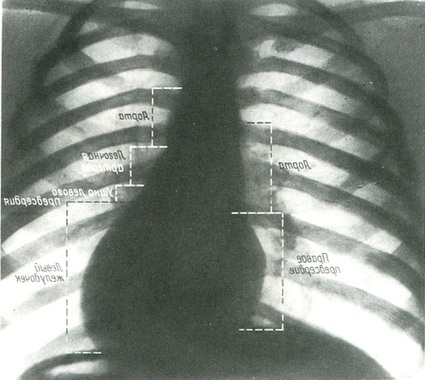 оглядовий знімок серця