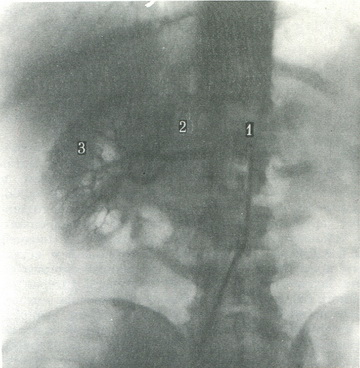 селективна артериограмма правої нирки