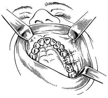 пластичне закриття прориву дна щелепної пазухи