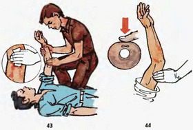 притиснення судини і артерії