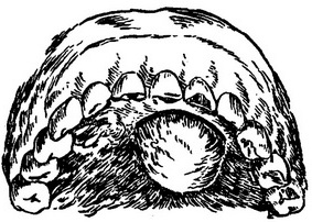 лінія розрізу при розтині абсцесу на небі
