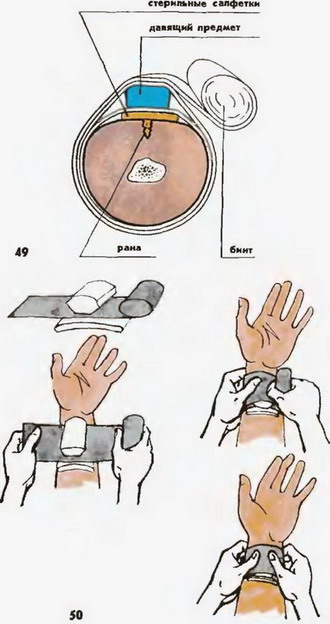накладання тугої пов'язки на рану