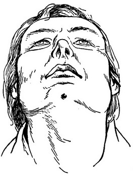 підборідний свищ