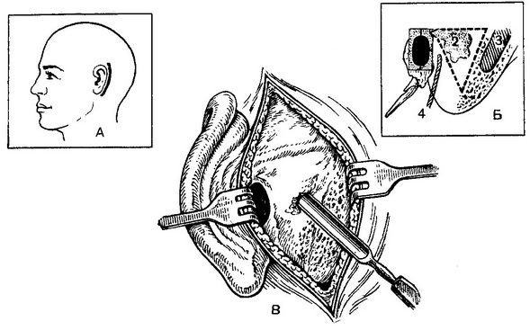 трепанації соскоподібного відростка