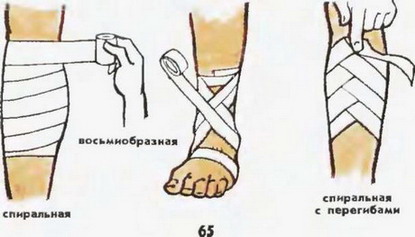 види бинтовых пов'язок